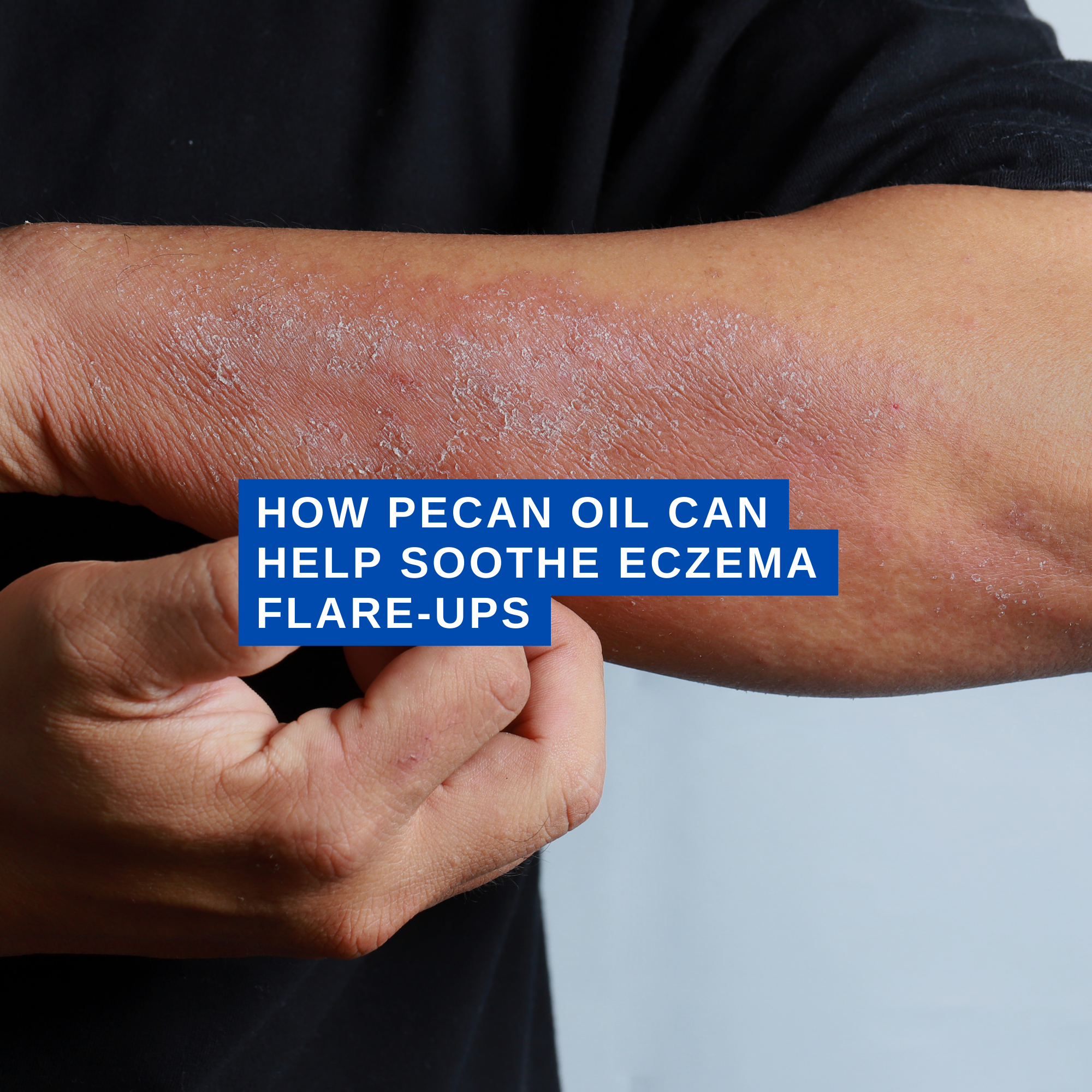 How Pecan Oil Can Help Soothe Eczema Flare-ups | Nuez Acres